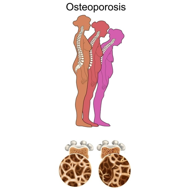 Osteoporosis Poster Print by Gwen Shockey/Science Source (18 x 24) - Osteoporosis Poster Print by Gwen Shockey/Science Source (18 x 24) -