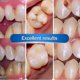 thumbnail image 4 of Dental Resin for Tooth Repair Strong Restoration Solution Cavity Filling Material, 4 of 4
