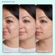 thumbnail image 3 of Gel Skinfix Acne+ Adapinoid® Resurface Clear Acne 30 ml, 3 of 8