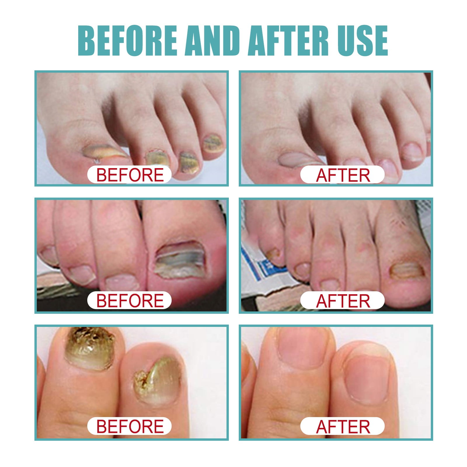 Fungal Nail Treatment - Foot & Ankle Experts Health Clinic