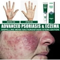 Ringworm Cream With Extra Strength Formula Safe, Fast Acting & 100