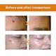 thumbnail image 5 of Spray de tratamiento de hidradenitis supurativa de verrugas con veneno de abeja, eliminación de marcas en la piel, eliminador de verrugas con veneno de abeja, congelación de verrugas, 5 of 5
