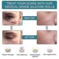 thumbnail image 5 of Silicone Scar Stickers Medical Silicone Easy-tear Gel Tape Roll Medical Grade, 5 of 5