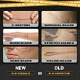thumbnail image 5 of Skin Grip Medical Grade Silicone Scar Tape 1.6"x120" Roll -Increased Strength & Reduced Irritation - Silicone Scar Sheets For Face, Surgical Scars, C-Section, Keloid Treatment, Tummy Tuck - Black, 5 of 7