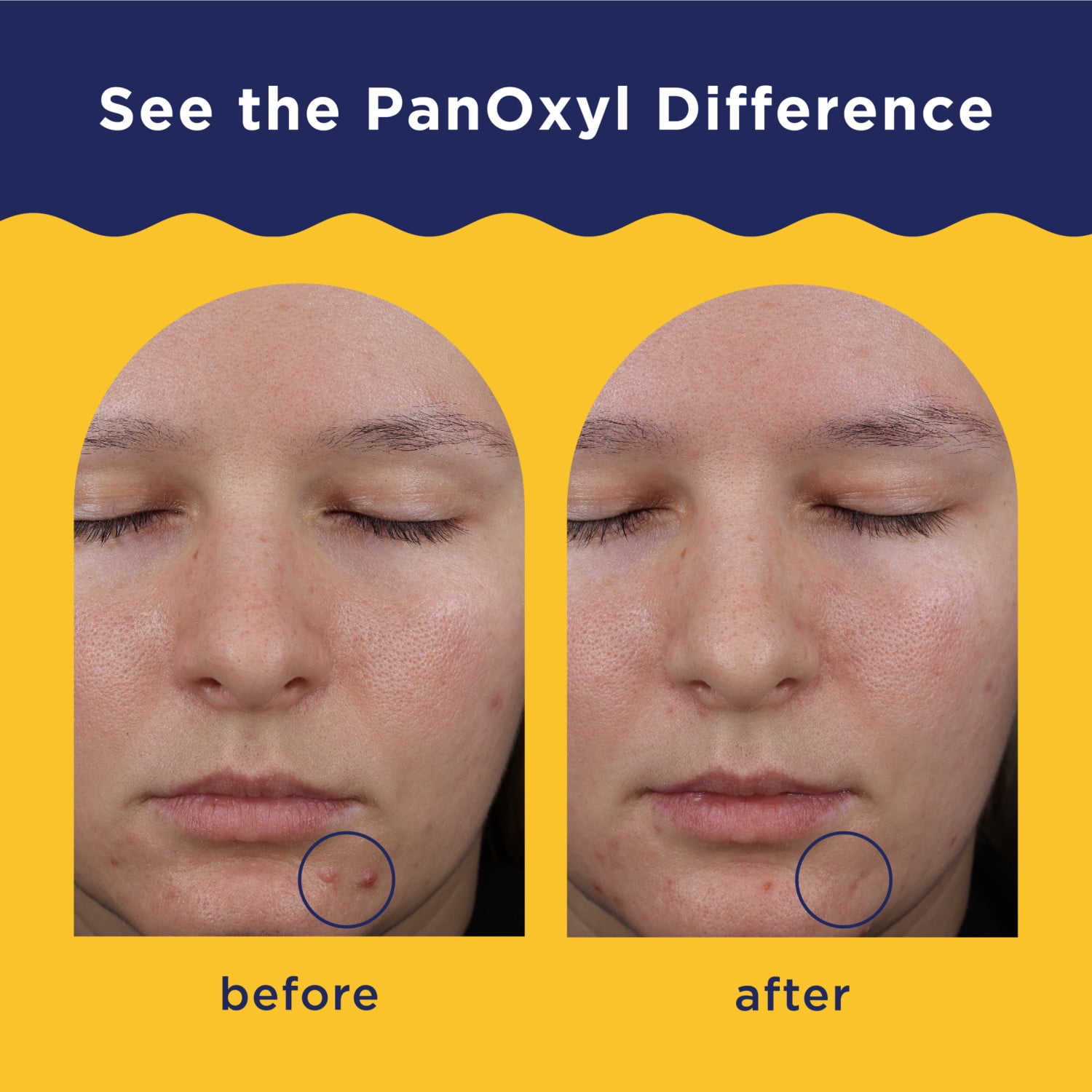 PanOxyl Pore Refining Acne Mask, 5% Sulfur, Unclogs Pores, 3 oz
