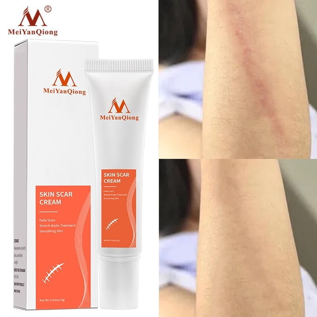 Crema de ácido salicílico para el acné, elimina las espinillas, Control de aceite, tratamiento antiacné, reparación de granos, acné, cicatriz, cuidado de la piel"face serum" Fivean LED