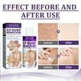 Keratosis Pilaris Repair Cream Natural Ingredients Exfoliating Cream