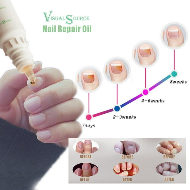 Nail Polish Antifungal