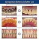 thumbnail image 4 of 30ml Calculus Dissolving Dental Spray Oral Tooth Cleaner Tartar Remover Tw, 4 of 4