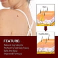 thumbnail image 3 of Eliminador de verrugas Pen Skin Tag Mole Remover Elimina las verrugas de maíz en los pies Hk, 3 of 3