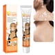 thumbnail image 2 of Crema de tratamiento de Vitiligo, lámpara de tratamiento de la piel con spray para aliviar el Vitiligo, pomada de eliminación de manchas blancas, 2 of 5