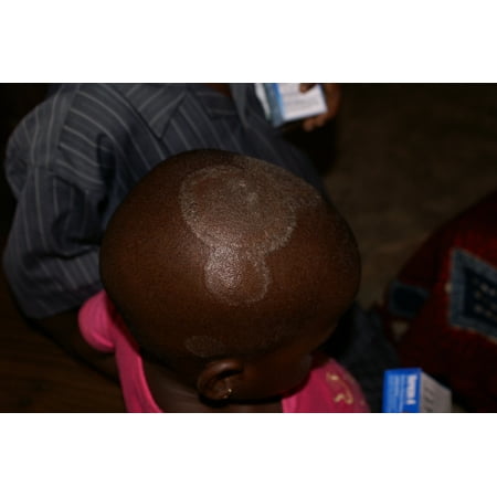 LAMINATED POSTER Ringworm, fungal and scalp infections are common in many small villages in Benin. Two dermatologists Poster Print 24 x