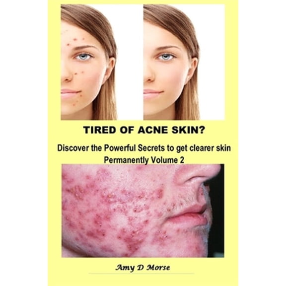 Pre-Owned TIRED OF ACNE SKIN? Discover the Powerful Secrets to get Clearer Skin Permanently