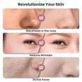 thumbnail image 4 of Máquina de microdermoabrasión UNOISETION Diamond Blackhead Remover, 4 of 8