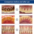 thumbnail image 4 of 2x Tartar Dissolving Oral Spray Anti-halitosis Tartar Lasting Fragrance Retention Dissolving And Removing Dental Calculus, 4 of 5