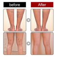 thumbnail image 2 of Ungüento de masaje para venas varicosas para aliviar los vasos sanguíneos abultados en las piernas, 2 of 3