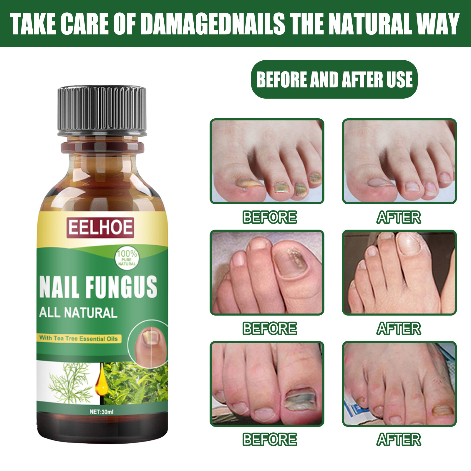 3 Pack Nail Treatment for Toenails & Fingernails - With Tea Tree Oil ...