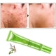 thumbnail image 5 of Promotional activities!Acne Remove Acne Oil Control Oil Shrink Pores Whitening and Moisturizi, 5 of 9