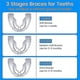 thumbnail image 5 of Anti Snoring Bruxism Mouth Guard 3 Stages Dental Orthodontic Braces Teeth Retainer Sleeping Bruxismo Snoring, 5 of 5