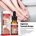 thumbnail image 3 of Aceite De Corrección De Uñas Encarnadas Gotas Para Uñas Encarnadas Cuidado De Uñas Para Uñas Encarnadas, 3 of 8