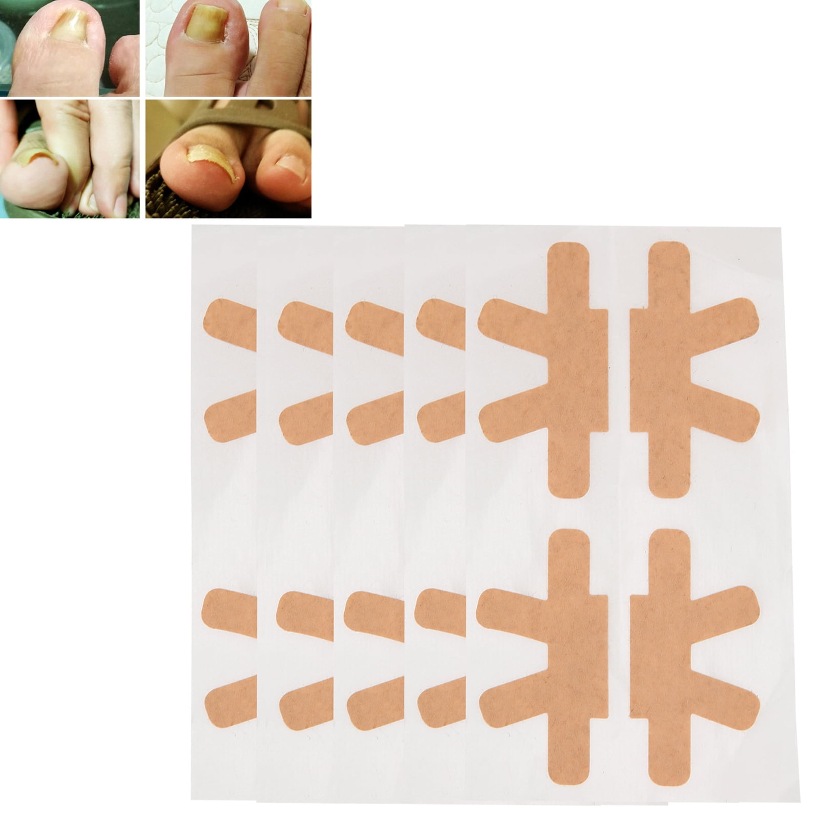 ESTINK Toe Nail Correction Bandage,Ingrown Toenail Corrector Stickers