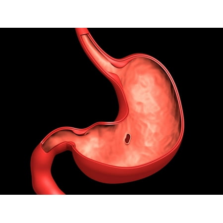 Conceptual image of peptic ulcer in human stomach Stretched Canvas - Stocktrek Images (17 x