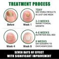 thumbnail image 3 of 7days Nail Treatment, Ginger Nail Treatment, Multi-purpose Nail Repair, Nail Nutrient Oil Strengthener Oil Serum Ginger Nail Growth Oil 2025, 3 of 5