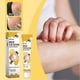 thumbnail image 3 of Vitiligo Bee-Venom Treatment Cream for Skin Pigmentation, Psoriasis Relief, Reduces White Spots, Portable Anti-itch Ointment for All Skin Types, 3 of 5