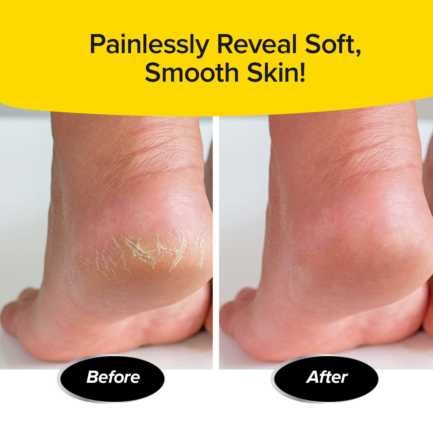 PedEgg Power Cordless Motorized Callus Remover w/ Bright LED Light As Seen On TV, Quickly Removes Calluses