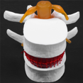 thumbnail image 3 of 2X Human Anatomy Skeleton Spine Lumbar Disc Herniation Teaching Model Brain Traumatic School Supplies Instrume, 3 of 9