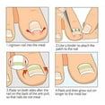 thumbnail image 4 of Dedicated Ingrown Nail Orthodontic Correction Patch Inflammation Manicure Clippers, 4 of 5
