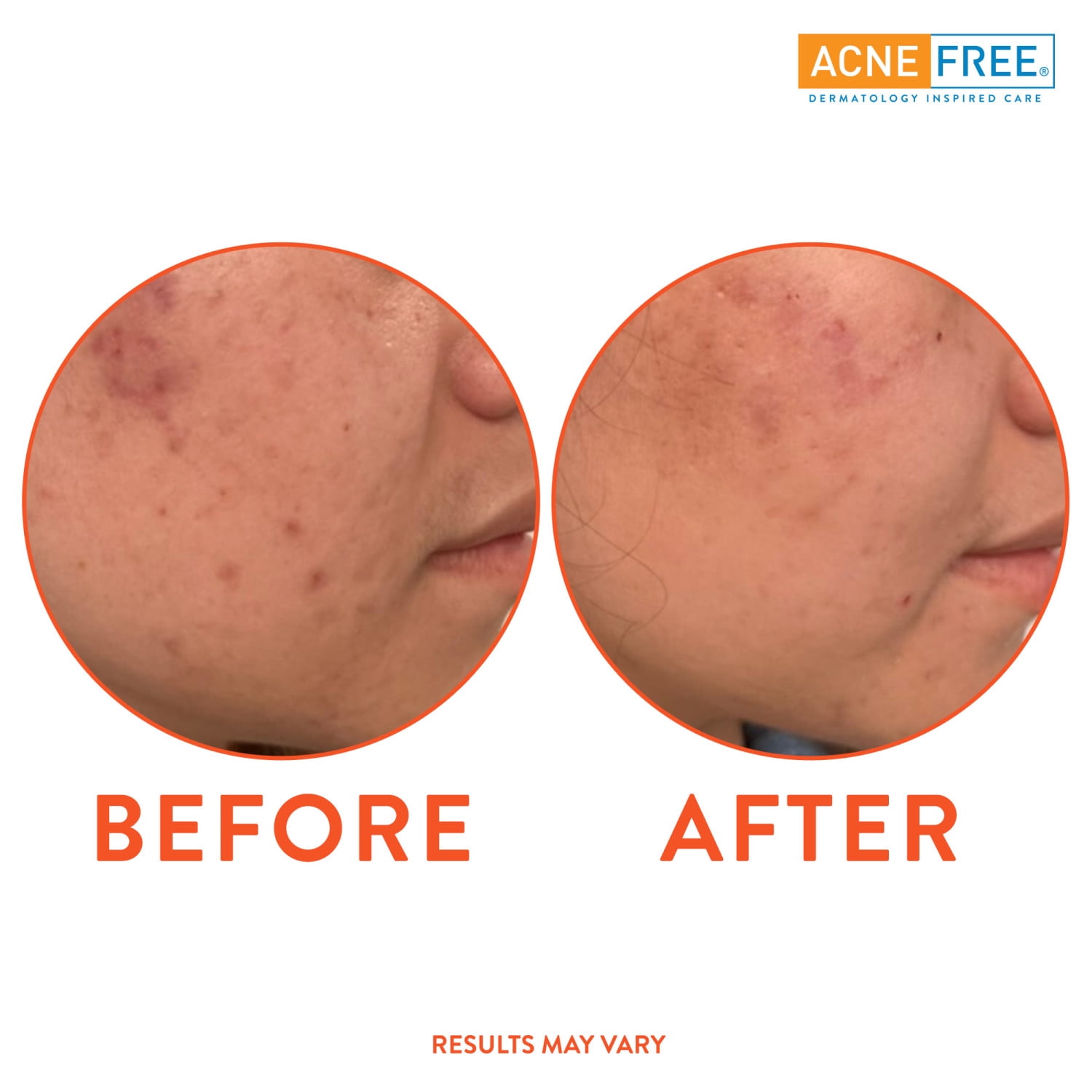 Acne Free Oil Free 24 Hour Acne Treatment Kit, 3 Step Acne Clearing System