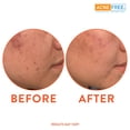 thumbnail image 7 of Acne Free Oil Free 24 Hour Acne Treatment Kit, 3 Step Acne Clearing System, 7 of 7