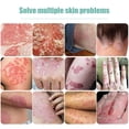 thumbnail image 3 of Ungüento para Psoriasis, Dermatitis, Eczema, alivia las alergias de la piel, pomada para prurito de la piel de manos y pies, 1-3-5 Uds., 3 of 4