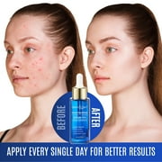 Dermaxgen 10% Niacinamide Serum for Smooth, Bright & Youthful Skin, Pore Reducer + Uneven Skin Tone Treatment, Treat Dark Spots, Diminishes Acne Prone, Skin Balancing, Restores Elasticity