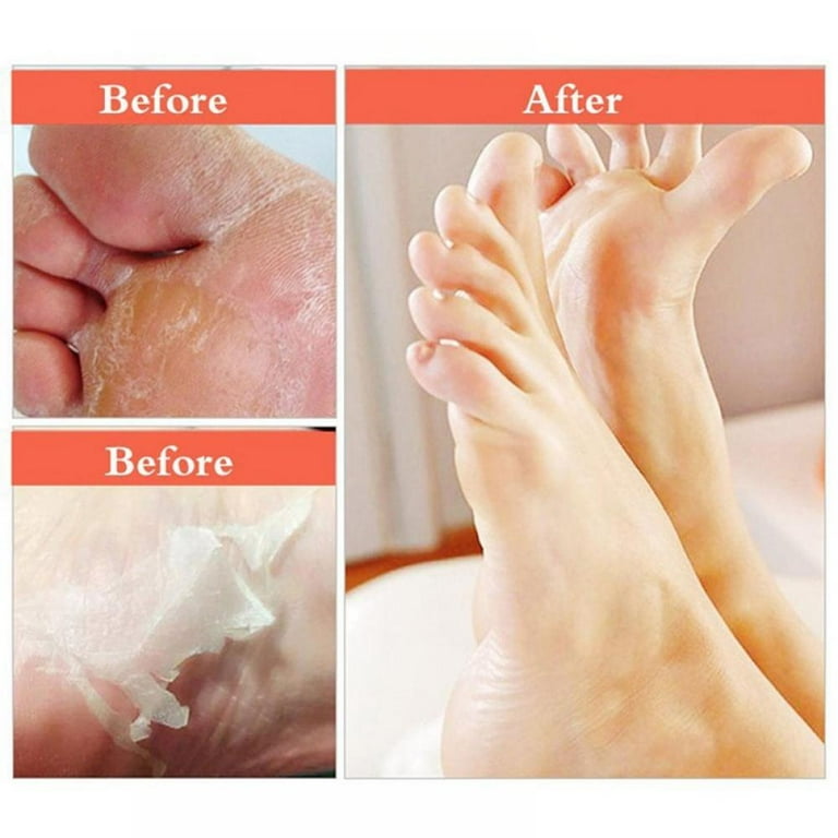 Exfoliating Feet Care Remove Dead Skin Cuticles Heel Pedicure - China  Pedicure and Exfoliating Foot Care Pedicure price