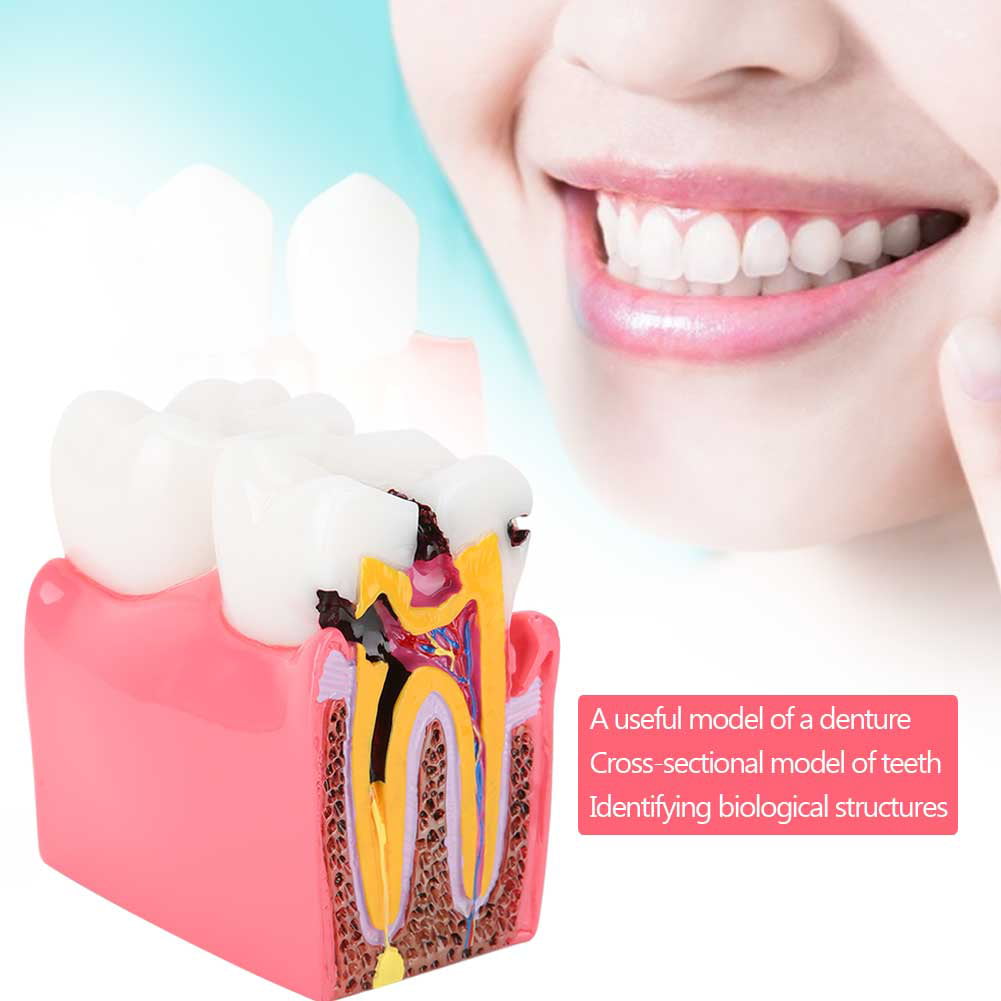 Caries Comparison Study Models Dentist Dental Anatomy Education Teeth Model 