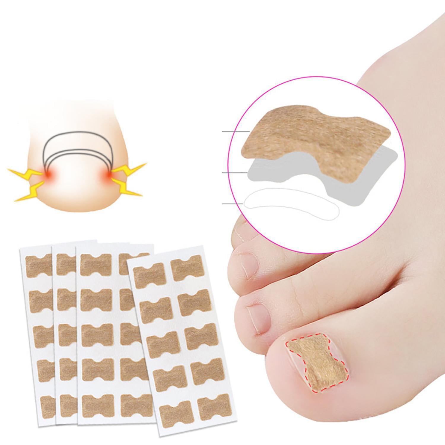 10 pcs Correção Toe Nail Strip Adesivo Anti-roll Nail Toe Inlay Unhas Órteses |  Walmart Canadá