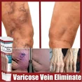 thumbnail image 2 of Crema para tratamiento de venas varicosas, angitis, piernas, alivio dilatado, Vasculitis, flebitis, pierna Araña, Varicosity, medicina para el cuidado de los pies, 2 of 5