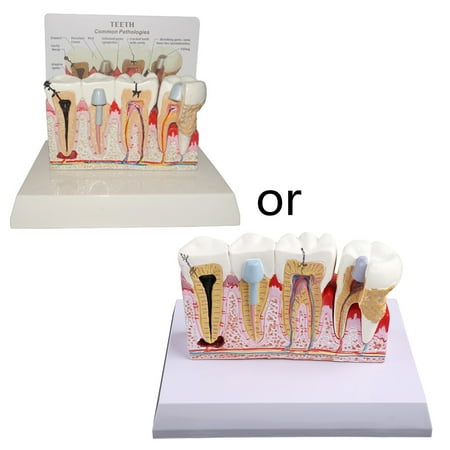 

TINYSOME 7x5.9x5.1in Patient Education&Explanation Treatment Model for Study Teach Decay Teeth Model Tooth Pathology Display