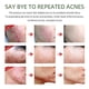 thumbnail image 4 of Joypretty Tea Tree Acne Cream Fades Acne Print Herbal Acne Cream, 4 of 4
