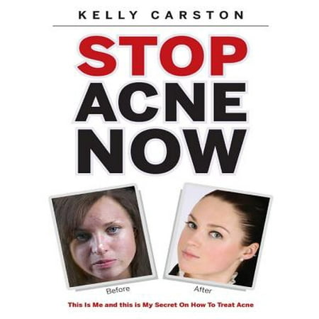 Stop Acne Now: This Is Me and This Is My Secret On How to Treat Acne -