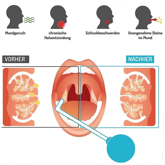 Oral Hygiene Tool: Tonsil Stone Remover, Freshen Breath  Clean Throat, Comfortable Grip
