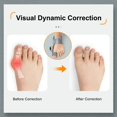thumbnail image 3 of Bunion Corrector Adjustable Hallux Valgus Big Toe Corrector Rotatable Toe Corrector Straightener Adjustable Toe Correction, 3 of 4