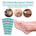thumbnail image 4 of Corrección de uñas Uña encarnada Uña del pie Parche Corrector Herramientas de pedicura Parche de corrección de uña encarnada Uña del dedo del pie Alisador de uñas F TUNC Sencillez, 4 of 5