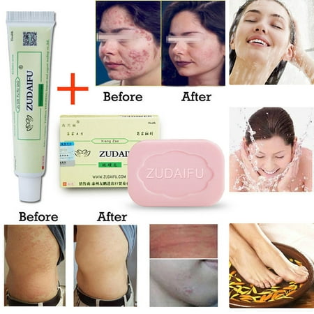 Zudaifu Antibacterial Psoriasis Eczema Cream Massage Plus Zudaifu Herbal