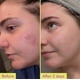thumbnail image 3 of Tratamiento de Ácido Azelaico Good Molecules 10% para el Rostro 30 mL, 3 of 7