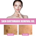 thumbnail image 2 of 1/2Pcs Birthmark Remover Oil Birthmark Lightening Oil, 2 of 5