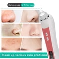 thumbnail image 1 of Facial Cleaning Machine Blackhead Suction Blackhead Removal Machine Electric Facial Blackhead Cleansing Vacuum Suction Machine With 20X 5MP Visual Function, 1 of 8