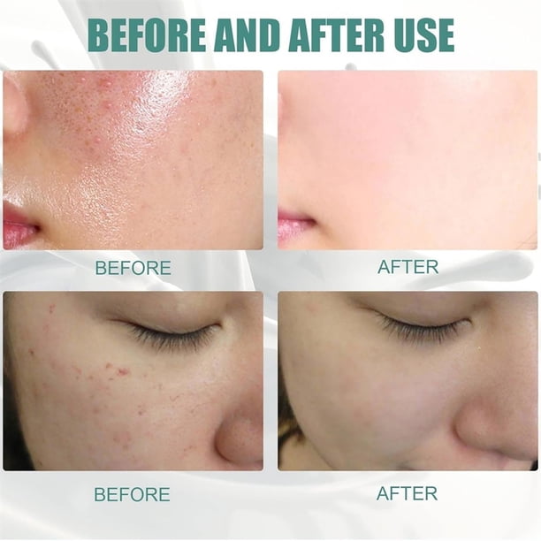 miracle white glutathione cost Miracle White 80000Mg Glutathione Injection White Box - Recommended For:  Adults - Recommended For: Adults at 12500.00 INR at Best Price in Bengaluru